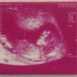 farbiges Baby Ultraschallbild